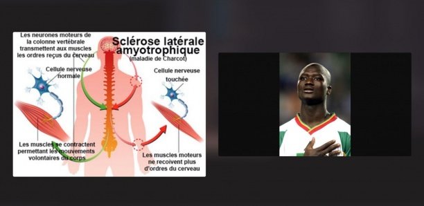 Qu'est-ce que la maladie de Charcot dont souffrait Pape Bouba Diop