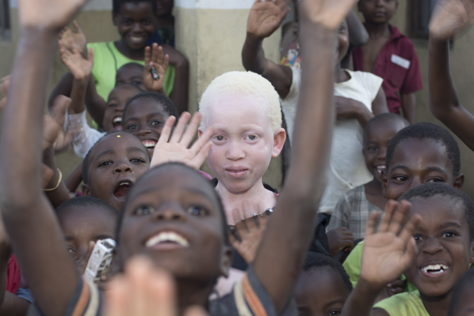 VIOLENCE TOUT COURT OU VIOLENCES ELECTORALES:  Amnesty International veut éviter que les albinos soient victimes de sacrifices humains