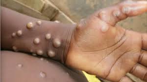 surveillance sanitaire du Mpox