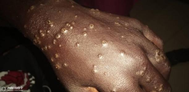 ETRANGE ÉPIDÉMIE À THIAROYE SUR MER: Plus de 200 pêcheurs atteints de dermatoses inexplicables