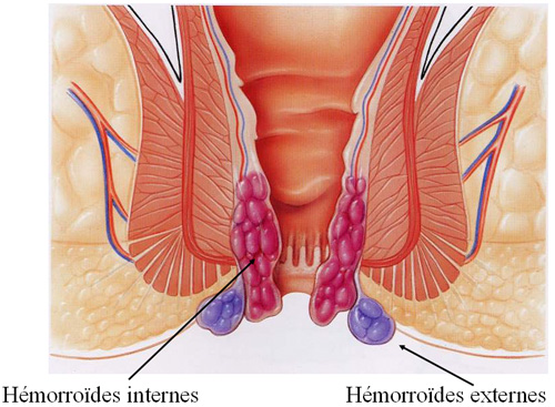 Hémorroïdes : la maladie taboue pour les jeunes avec  des préjugés de connard qui stress et font mal au coeur !