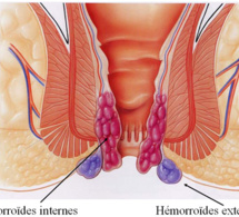 Hémorroïdes : la maladie taboue pour les jeunes avec  des préjugés de connard qui stress et font mal au coeur !